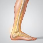 Illustration médicale montrant le nerf sural longeant le mollet et le bord extérieur du pied, avec une zone de douleur localisée sur le côté externe du pied.